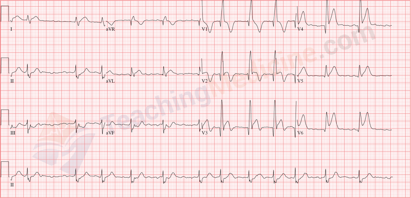 alcohol calcium channel blockers